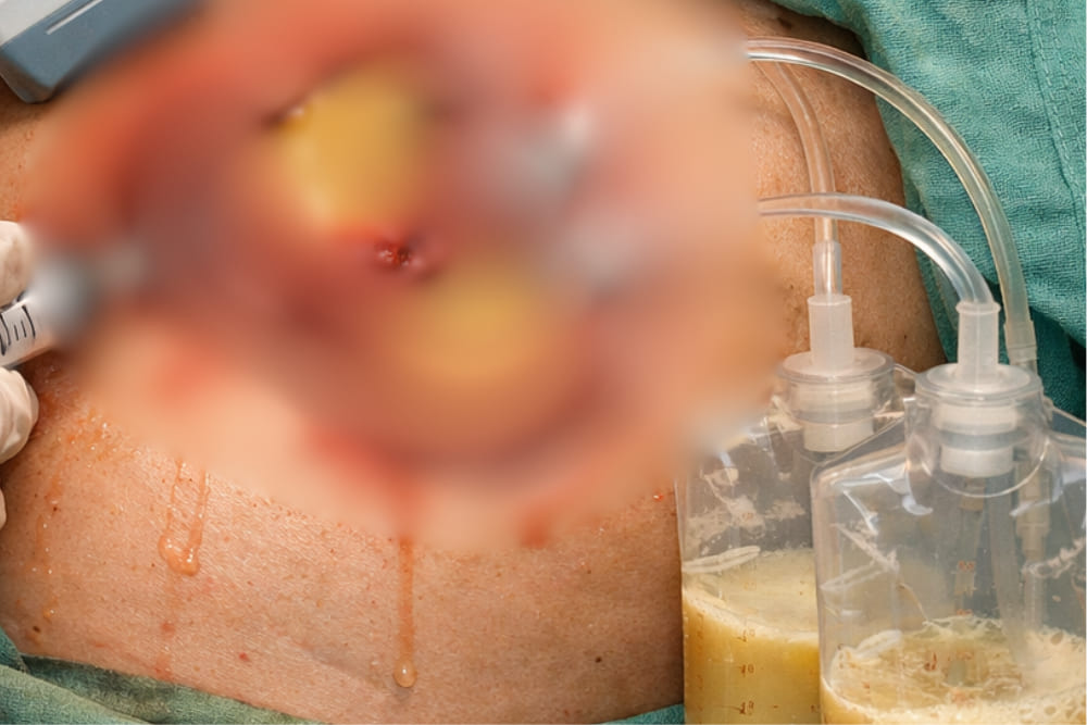 Drenaje de abscesos hepáticos en Puebla: tratamiento para infecciones del hígado