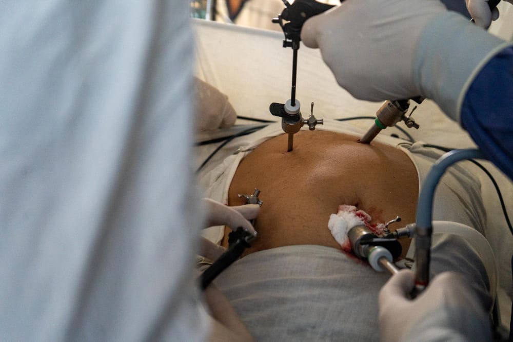 Laparotomía por abdomen agudo como urgencia en Puebla: cirugía de emergencia para enfermedades abdominales graves