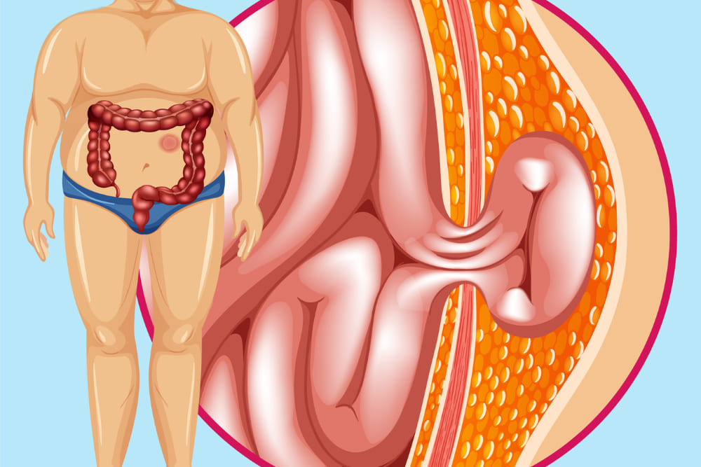 Reparación de hernias